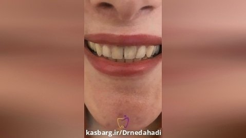 کامپوزیت دندان توسط دکتر ندا هادی-دندانپزشک زیبایی