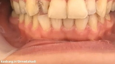 کامپوزیت دندان و اصلاح طرح لبخند