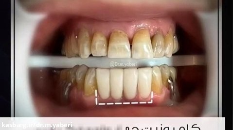 کامپوزیت دندان جهت بستن فضای باز بین دندانی