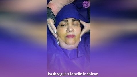 لیپوساکشن غبغب در کلینیک لیان شیراز