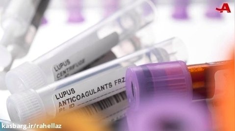 علائم بیماری لوپوس چیست؟