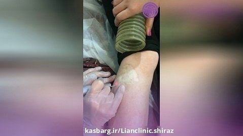درمان سالک در کلینیک لیان شیراز