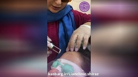 درمان کک و مک در کلینیک لیان شیراز