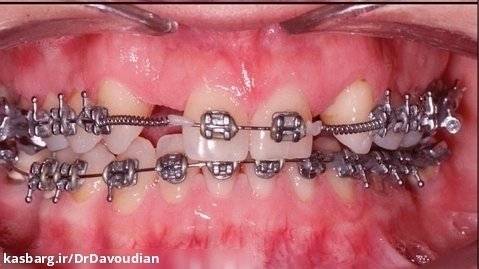 ارتودنسی دندانهای غایب برای ایمپلنت