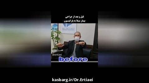 قبل و بعد جراحی پارکینسون توسط دکتر ابوالحسن ارتیاعی