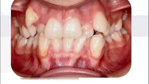 درمان نامرتبی شدید دندان