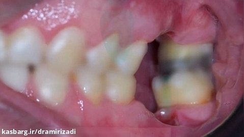 فیلم ایمپلنت دندان