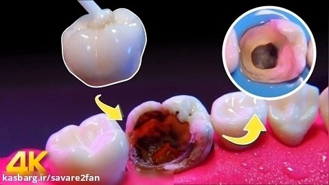 ترمیم فوق العاده دندان _ پرکردن دندان به زیبایی / دندانپزشکی