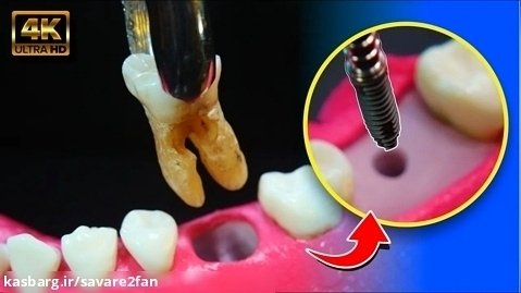 ایمپلنت دندانی / طریقه کاشت دندان آسیا و نصب آن دردهان