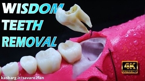 کشیدن دندان عقل با کیفیت 4K |  مراقبت های بعد از عمل